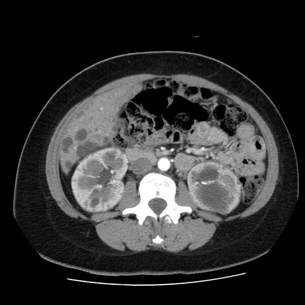 File:Autosomal dominant polycystic kidney disease (Radiopaedia 23061-23093 B 34).jpg