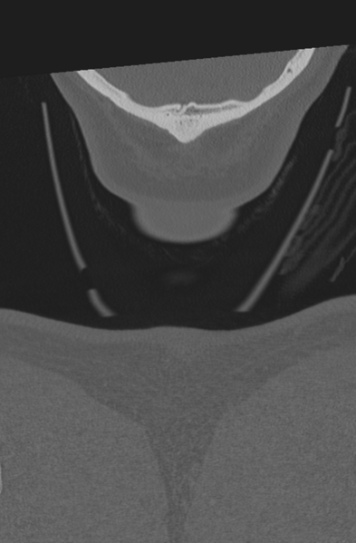 File:Axis peg fracture (type 3) and atlas lateral mass (type 4) fracture (Radiopaedia 37474-39324 Coronal bone window 79).png