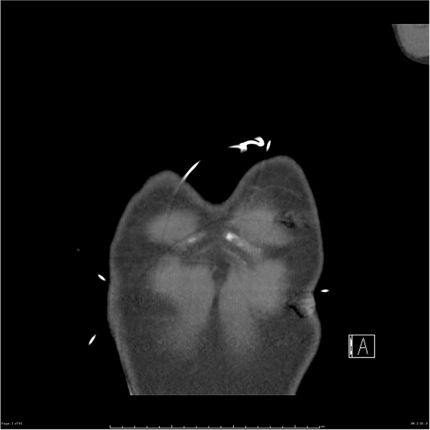 Azygos venous system anatomy (CT pulmonary angiography) (Radiopaedia 25928-26077 Coronal C+ CTPA 1).jpg
