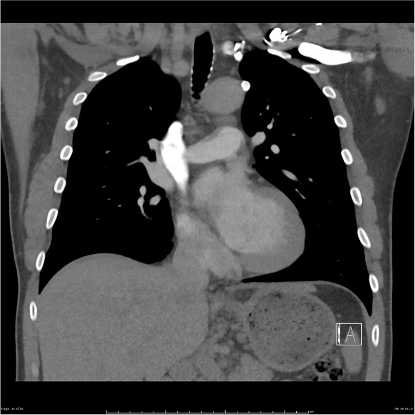Azygos venous system anatomy (CT pulmonary angiography) (Radiopaedia 25928-26077 Coronal C+ CTPA 35).jpg