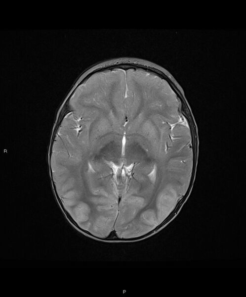 File:Basal ganglia and parenchymal ischemia (Radiopaedia 45818-50084 Axial T2 10).jpg