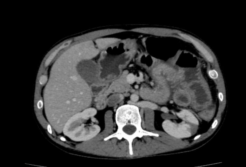 File:Behçet's disease- abdominal vasculitis (Radiopaedia 55955-62570 A 28).jpg