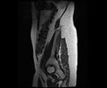 Bicornuate bicollis uterus (Radiopaedia 61626-69616 Sagittal T2 3).jpg