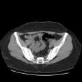 Bicornuate uterus- on MRI (Radiopaedia 49206-54296 Axial non-contrast 5).jpg