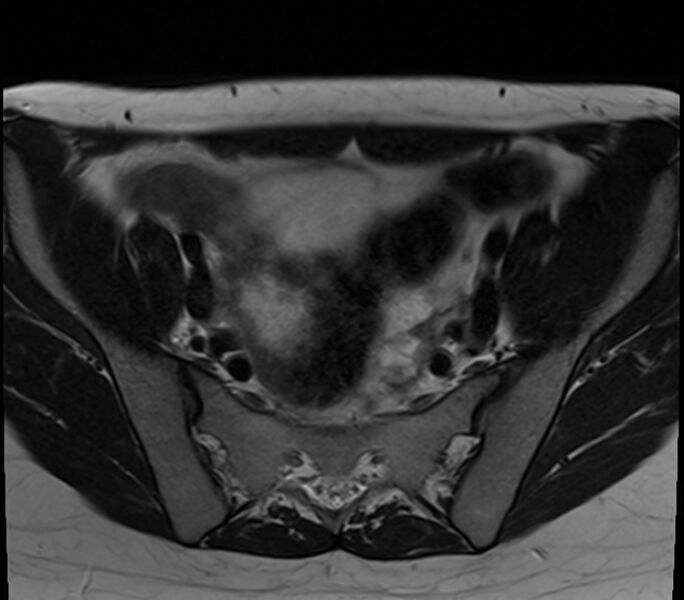 File:Bicornuate uterus (Radiopaedia 71214-81511 Axial T2 25).jpg