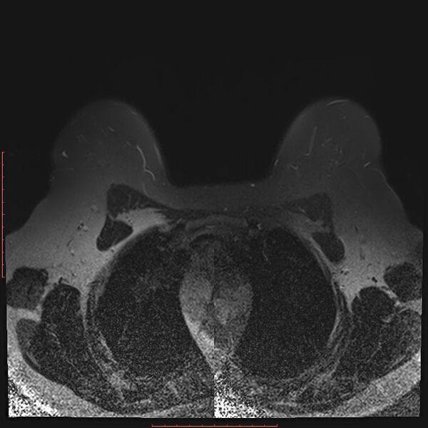 File:Bilateral breast implant rupture (Radiopaedia 24761-25027 T2 fat sat 8).jpg