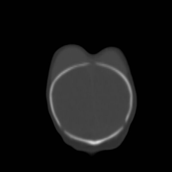 File:Bilateral cephalohematomas and subdural hematomas (Radiopaedia 26778-26929 Coronal bone window 32).jpg