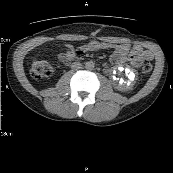 File:Bilateral medullary nephrocalcinosis with ureteric calculi (Radiopaedia 71269-81569 Axial non-contrast 60).jpg