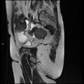 Bilateral ovarian fibroma (Radiopaedia 44568-48293 Sagittal T2 25).jpg