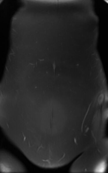 File:Bilateral ovarian fibrothecomas - adolescent (Radiopaedia 86604-102707 T1 C+ fat sat 3).jpg