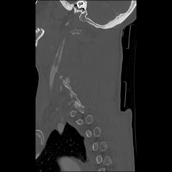 File:Bilateral perched facets with cord injury (Radiopaedia 45587-49713 Sagittal bone window 42).jpg