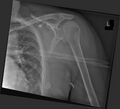 Bilateral posterior shoulder dislocation (Radiopaedia 54102-60281 A 1).jpg