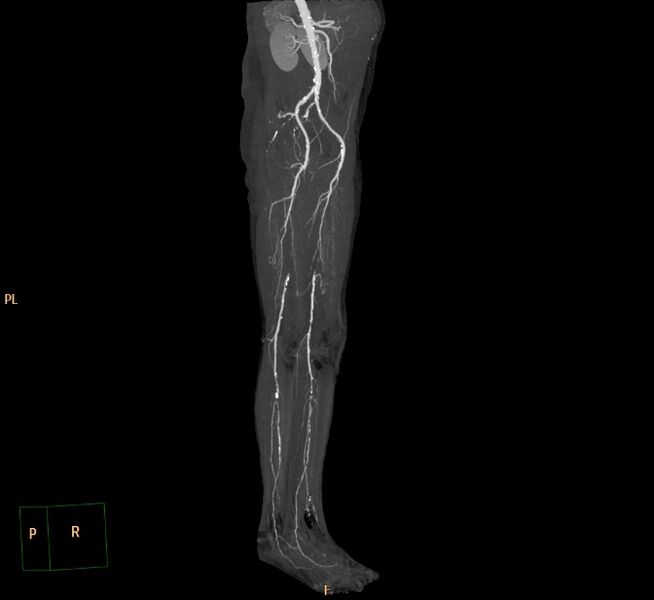 File:Bilateral superficial femoral arterial occlusion (Radiopaedia 25682-25857 3D MIP 9).jpg