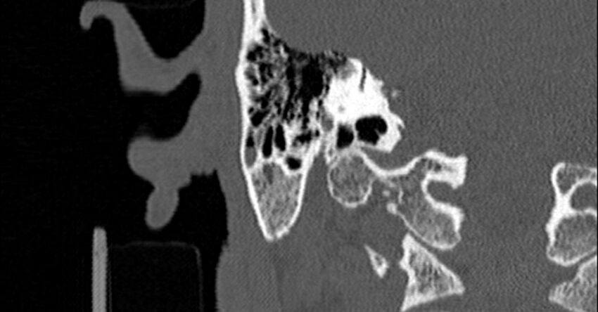Bilateral temporal bone fractures (Radiopaedia 29482-29970 Coronal non-contrast 135).jpg