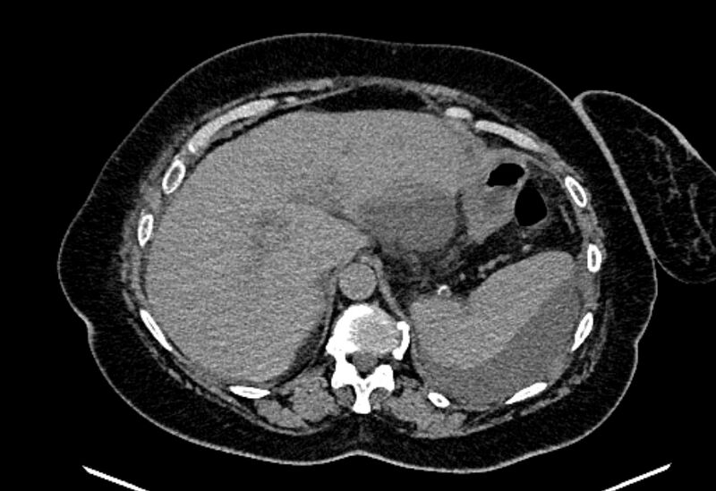 File:Biliary pancreatitis (Radiopaedia 72289-82823 Axial non-contrast 69).jpg