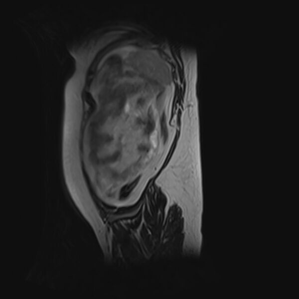 File:Bilobed placenta accreta (Radiopaedia 69648-79591 G 3).jpg