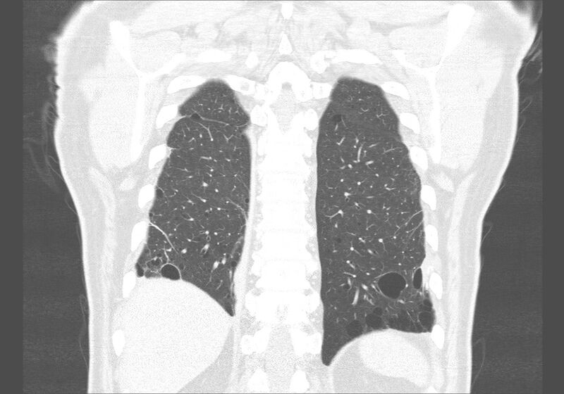 File:Birt-Hogg-Dubé syndrome (Radiopaedia 52578-58491 Coronal lung window 52).jpg