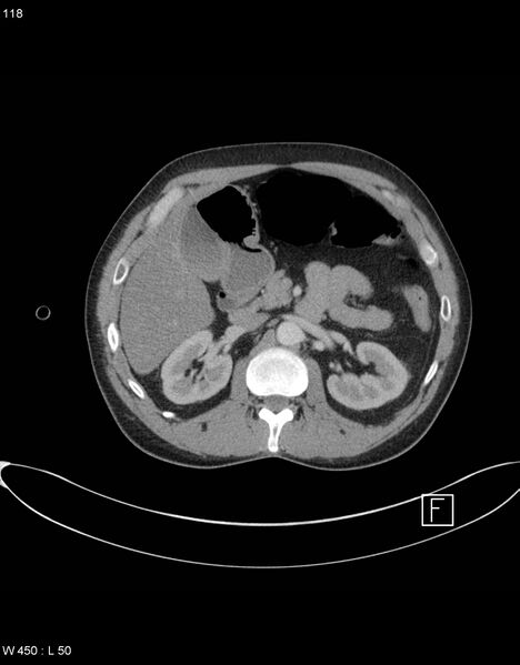 File:Boerhaave syndrome with tension pneumothorax (Radiopaedia 56794-63605 A 58).jpg