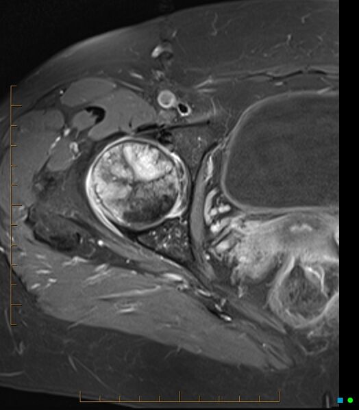 File:Bone metastasis - breast cancer (Radiopaedia 16667-16374 Axial T1 C+ fat sat 12).jpg