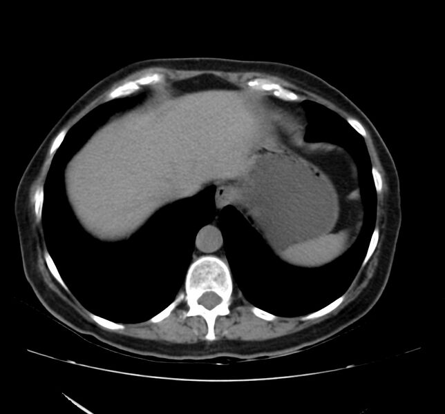 File:Bosniak renal cyst - type IV (Radiopaedia 22929-22953 Axial non-contrast 5).jpg