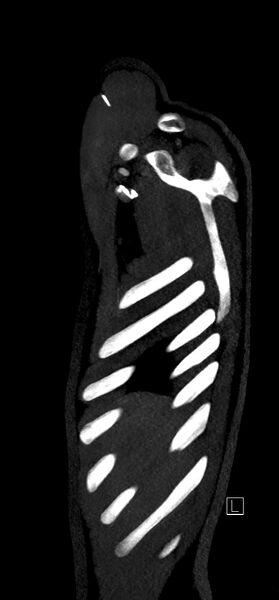 File:Brachiocephalic trunk pseudoaneurysm (Radiopaedia 70978-81191 C 8).jpg