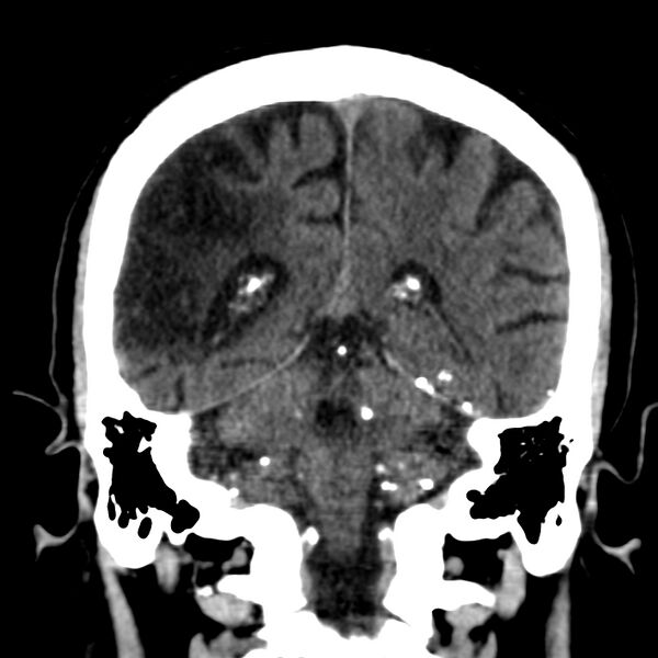 File:Brain Pantopaque remnants (Radiopaedia 78403-91048 Coronal non-contrast 47).jpg