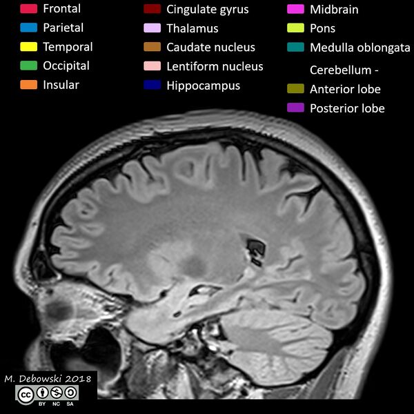 File:Brain lobes - annotated MRI (Radiopaedia 61691-69700 Sagittal 26).JPG