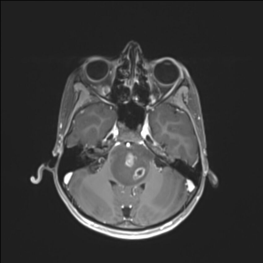 Brainstem glioma (Radiopaedia 70548-80674 Axial T1 C+ 45).jpg
