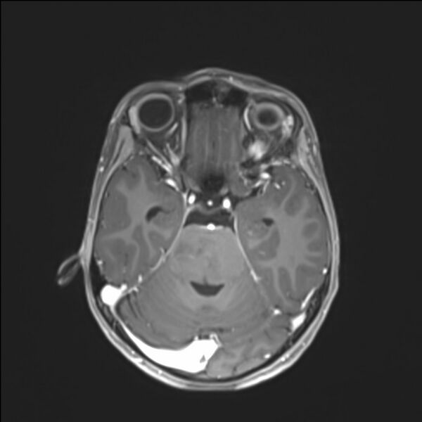 File:Brainstem glioma (Radiopaedia 70548-80674 Axial T1 C+ 59).jpg