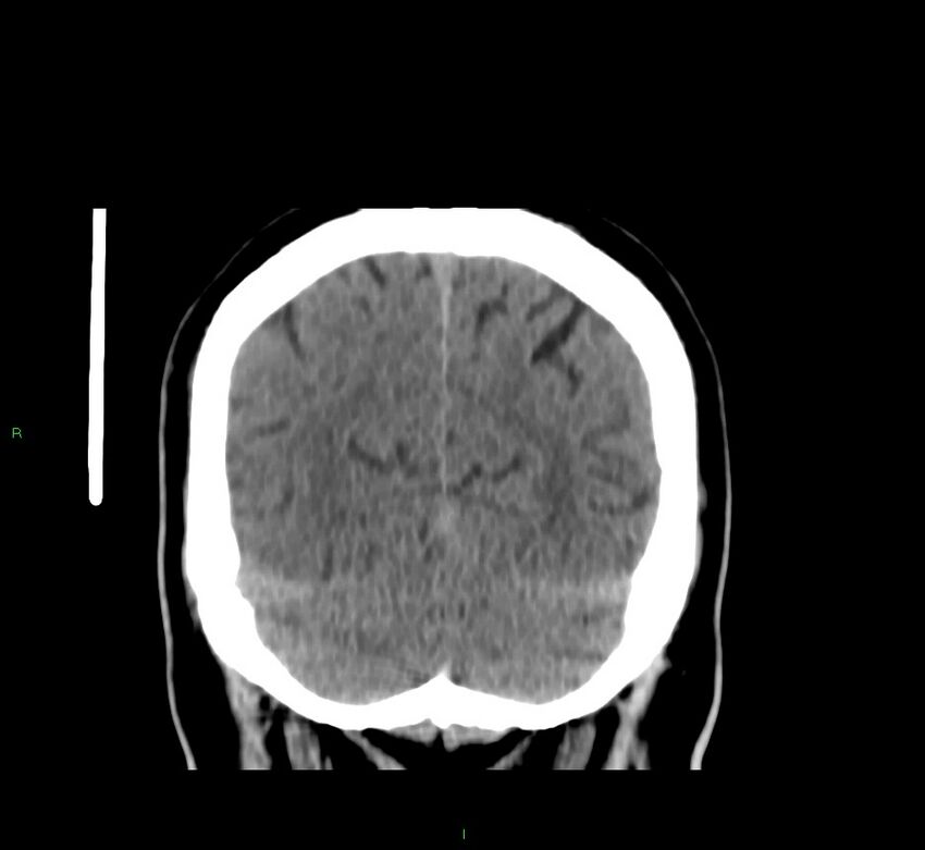 Brainstem hemorrhage (Radiopaedia 58794-66028 Coronal non-contrast 16).jpg