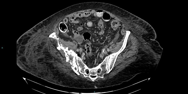 File:Breast cancer pelvic bony metastases (Radiopaedia 84470-99824 Axial bone window 35).jpg