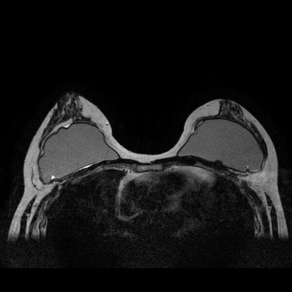 File:Breast implants - MRI (Radiopaedia 26864-27035 Axial T2 25).jpg