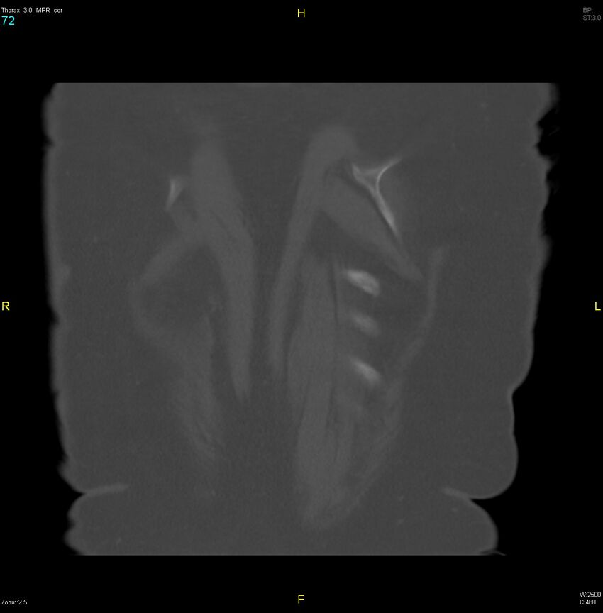 Breast primary with lung and bone metastases (Radiopaedia 40620-43228 bone window 72).jpg