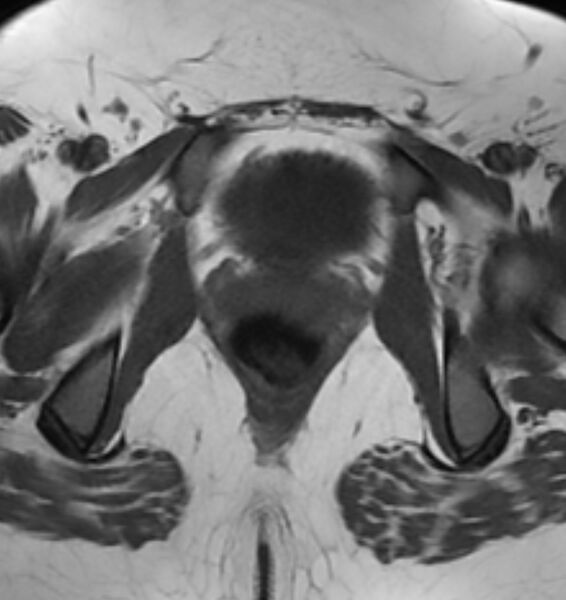 File:Broad ligament leiomyoma (Radiopaedia 81634-95516 Axial T1 23).jpg