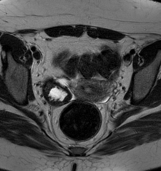 File:Broad ligament leiomyoma (Radiopaedia 81634-95516 Axial T2 14).jpg