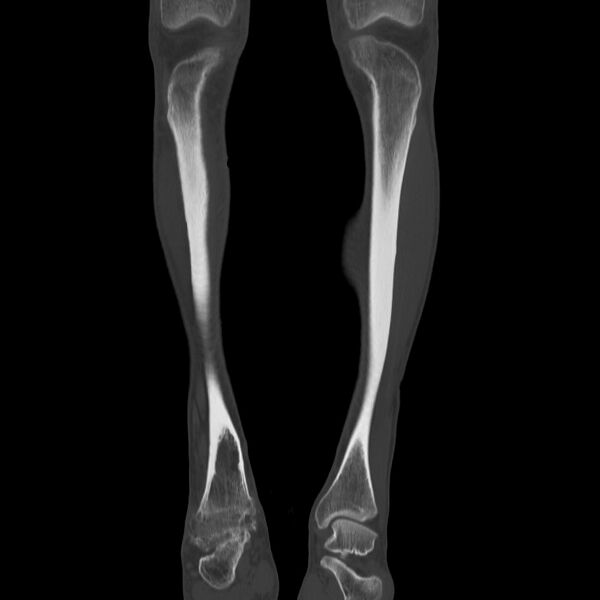 File:Brodie abscess - tibia (Radiopaedia 66028-75204 Coronal bone window 7).jpg