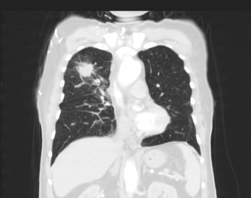 Bronchogenic carcinoma with lymphangitic spread (Radiopaedia 29002-29357 Coronal lung window 29).jpg