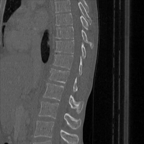 File:Bulging of paraspinal line in traumatic thoracal spinal compression fracture (Radiopaedia 29221-35872 Sagittal bone window 27).jpg