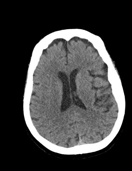 File:Burnt-out meningioma (Radiopaedia 51557-57337 Axial non-contrast 27).jpg