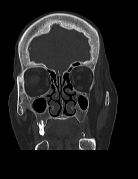 File:Burnt-out meningioma (Radiopaedia 51557-57337 Coronal bone window 10).jpg
