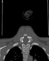 Butterfly vertebra (Radiopaedia 77903-90209 Coronal bone window 61).jpg