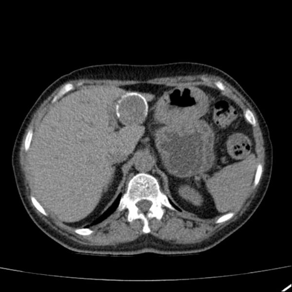 File:Calcified hepatic hydatid cyst (Radiopaedia 26872-27046 Axial non-contrast 23).jpg