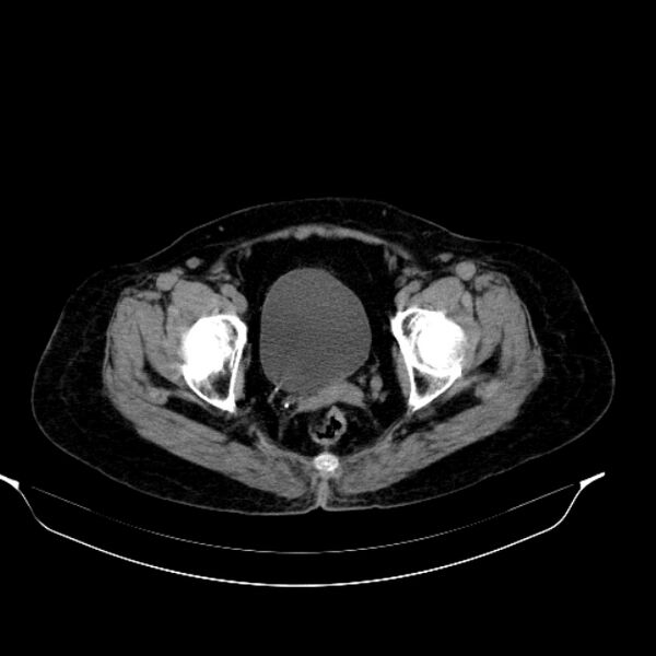 File:Calcified hydatid cyst (Radiopaedia 62000-70085 Axial non-contrast 100).jpg