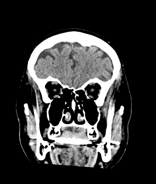 File:Calcified meningioma (Radiopaedia 74361-85243 Coronal non-contrast 10).jpg