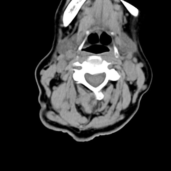 File:Calcified meningioma - cervical canal (Radiopaedia 70136-80171 B 16).jpg