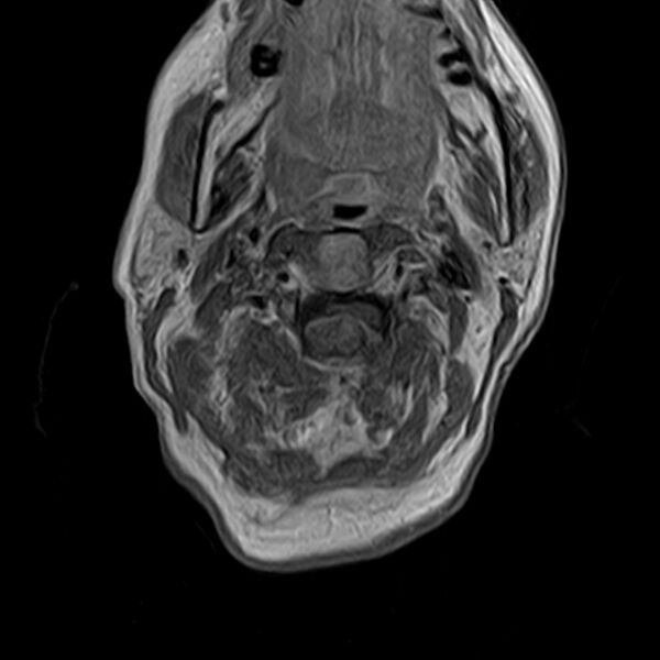 File:Calcified meningioma - cervical canal (Radiopaedia 70136-82468 Axial T1 C+ 11).jpg