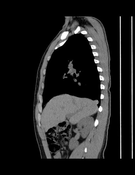 File:Calcifying pulmonary metastases (Radiopaedia 33359-34396 C 47).jpg
