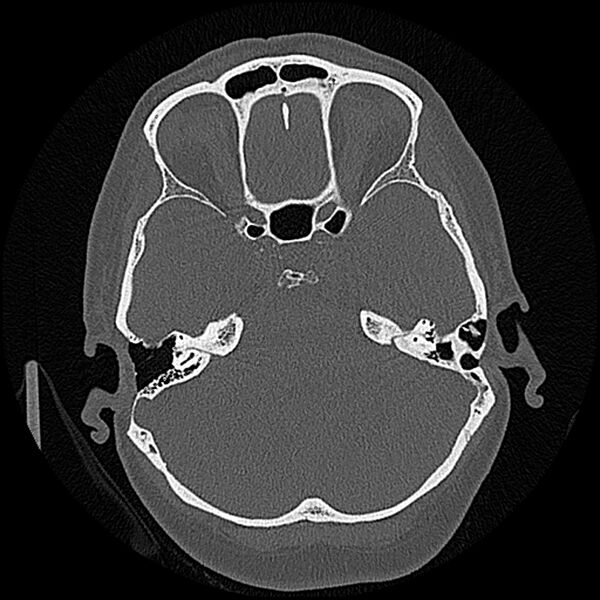 File:Canal up mastoidectomy (Radiopaedia 78108-90638 Axial bone window 97).jpg