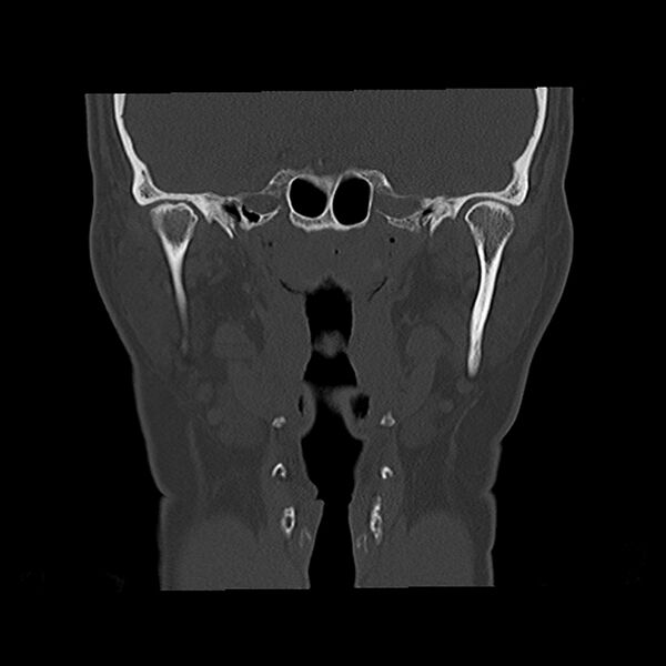 File:Canal up mastoidectomy (Radiopaedia 78108-90638 Coronal bone window 28).jpg