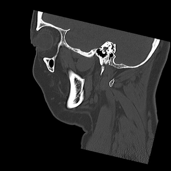 File:Canal up mastoidectomy (Radiopaedia 78108-90638 Sagittal bone window 16).jpg